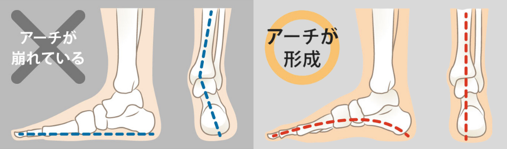 足裏アーチの比較 崩れたアーチと正常なアーチの骨格構造